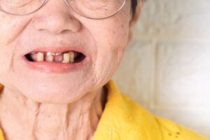 Is There A Possibility of Bone Loss In The Jaw If You Have a Missing Tooth?